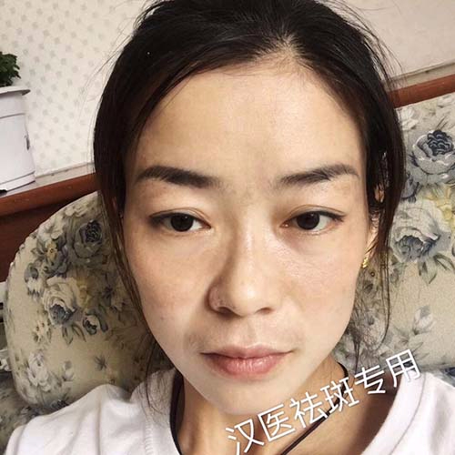 純中藥祛斑代理加盟招商